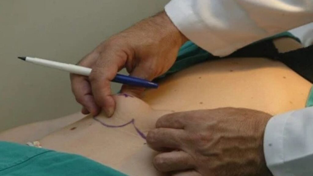 Havendo indicação médica, o plano de saúde deve cobrir a abdominoplastia.