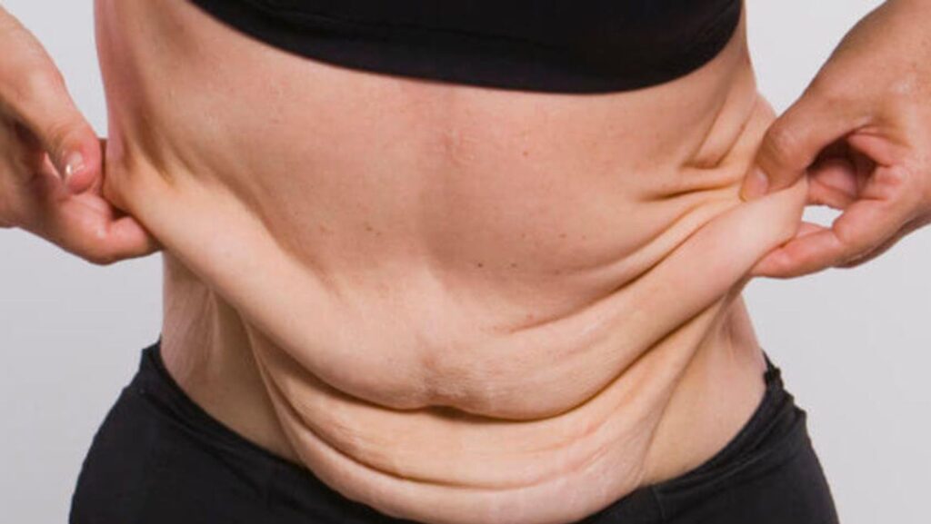 Havendo indicação médica, o plano de saúde deve cobrir a abdominoplastia.
