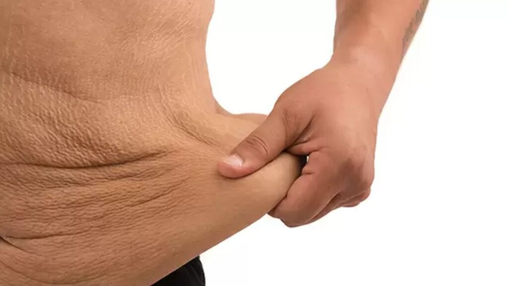 Havendo indicação médica, o plano de saúde deve cobrir a abdominoplastia.