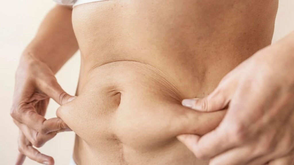 Havendo indicação médica, o plano de saúde deve cobrir a abdominoplastia.