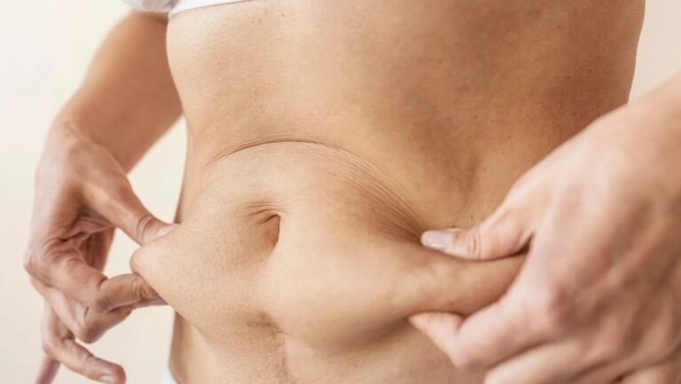 Havendo indicação médica, o plano de saúde deve cobrir a abdominoplastia.