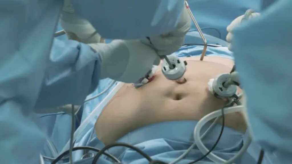 Havendo indicação médica, o plano de saúde deve cobrir a cirurgia bariátrica.