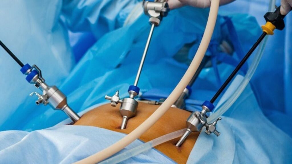Havendo indicação médica, o plano de saúde deve cobrir a cirurgia bariátrica.