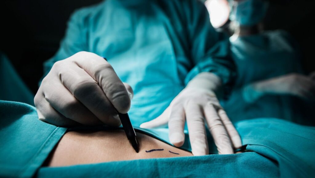 Havendo indicação médica, o plano de saúde deve cobrir a cirurgia bariátrica.