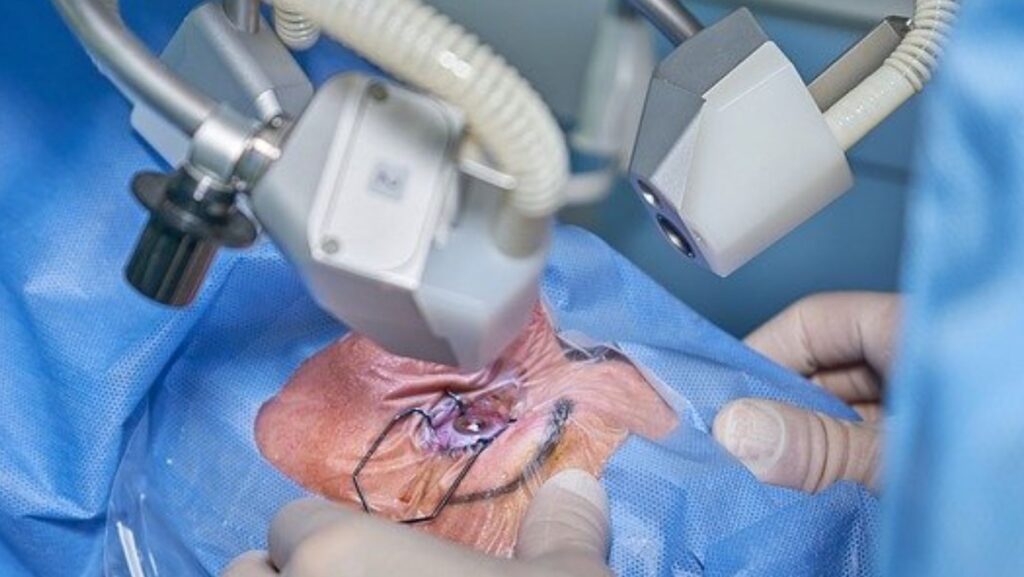 Havendo indicação médica, o plano de saúde deve cobrir a cirurgia refrativa.