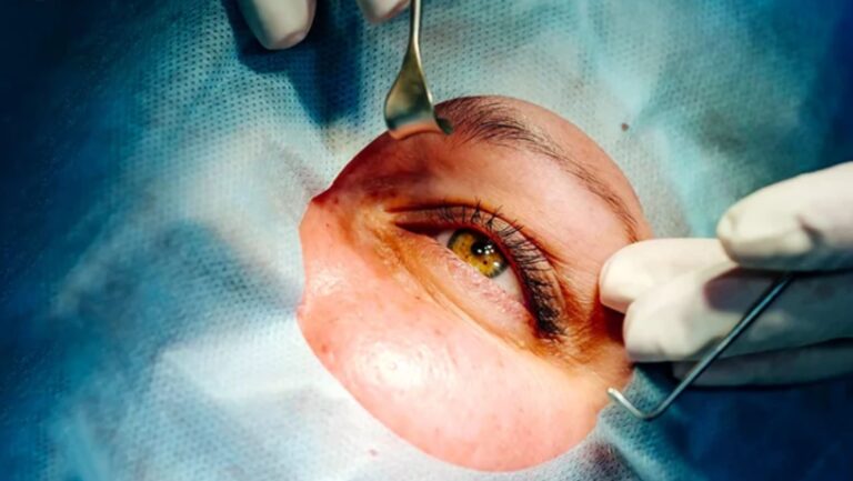 Havendo indicação médica, o plano de saúde deve cobrir a cirurgia refrativa.