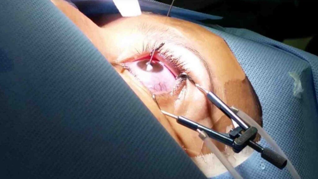 Havendo indicação médica, o plano de saúde deve cobrir a cirurgia refrativa.