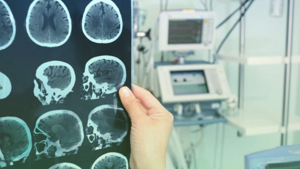 Havendo indicação médica, o plano de saúde deve cobrir o tratamento cirúrgico da epilepsia.