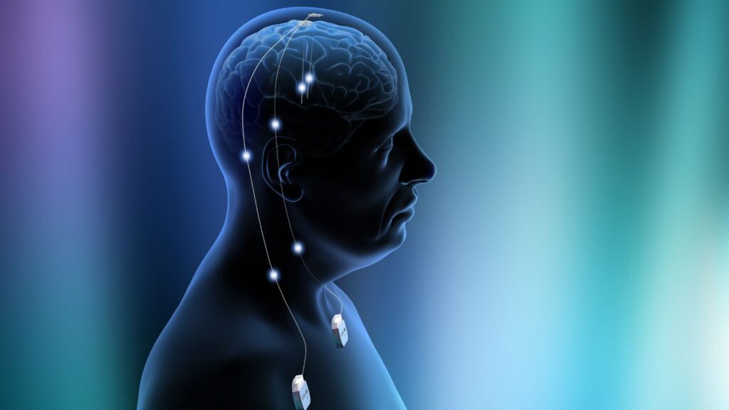 Havendo indicação médica, o plano de saúde deve cobrir a Estimulação cerebral profunda.