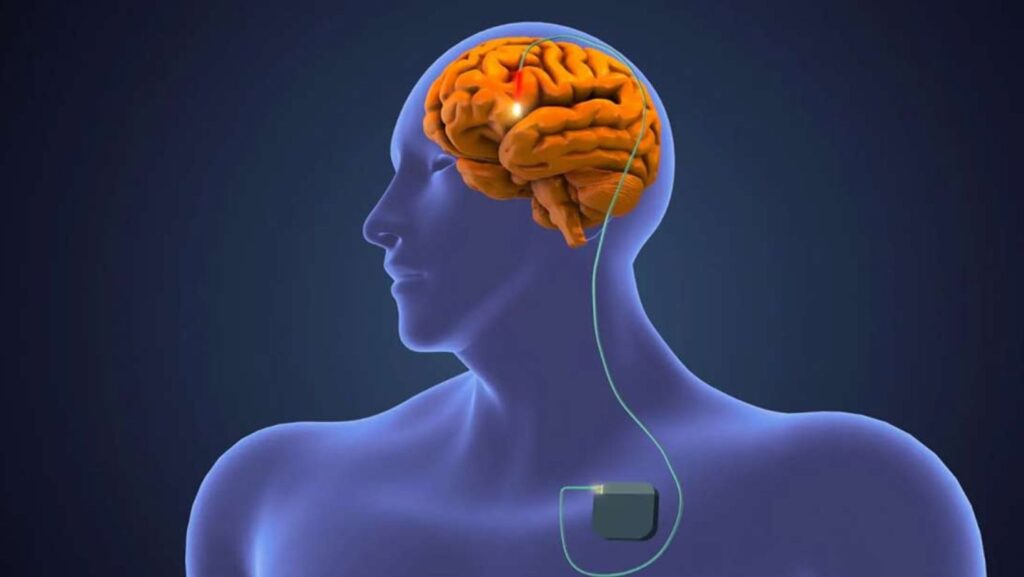 Havendo indicação médica, o plano de saúde deve cobrir a Estimulação cerebral profunda.