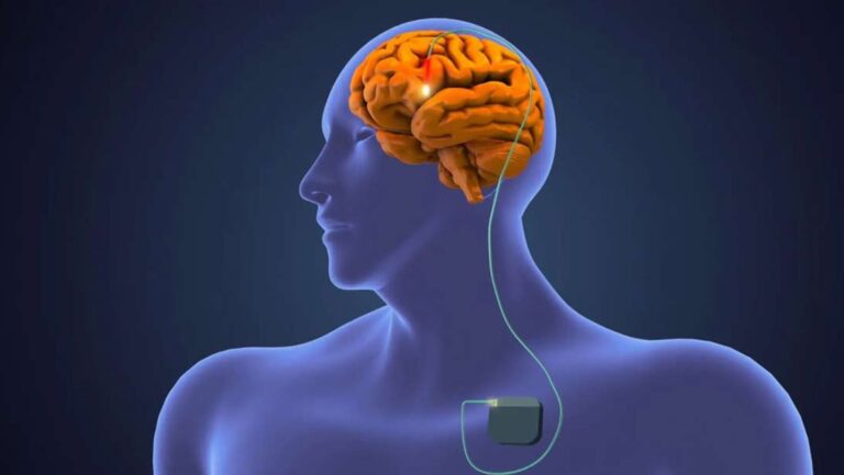 Havendo indicação médica, o plano de saúde deve cobrir a Estimulação cerebral profunda.