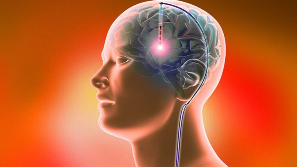 Havendo indicação médica, o plano de saúde deve cobrir a Estimulação cerebral profunda.