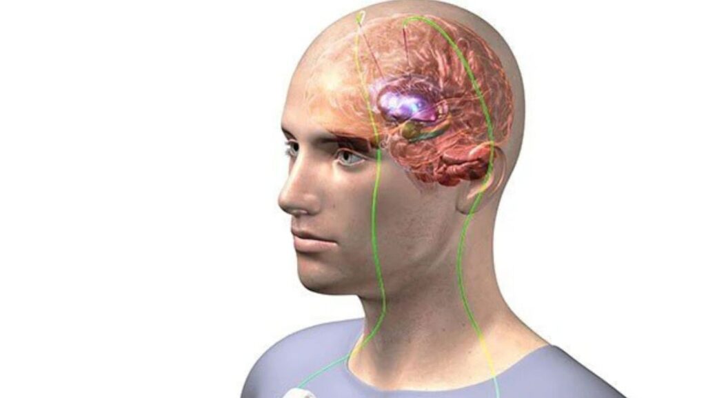 Havendo indicação médica, o plano de saúde deve cobrir a Estimulação cerebral profunda.