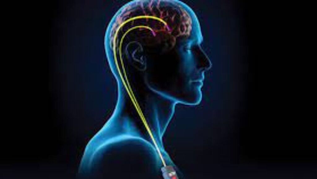 Havendo indicação médica, o plano de saúde deve cobrir a Estimulação cerebral profunda.