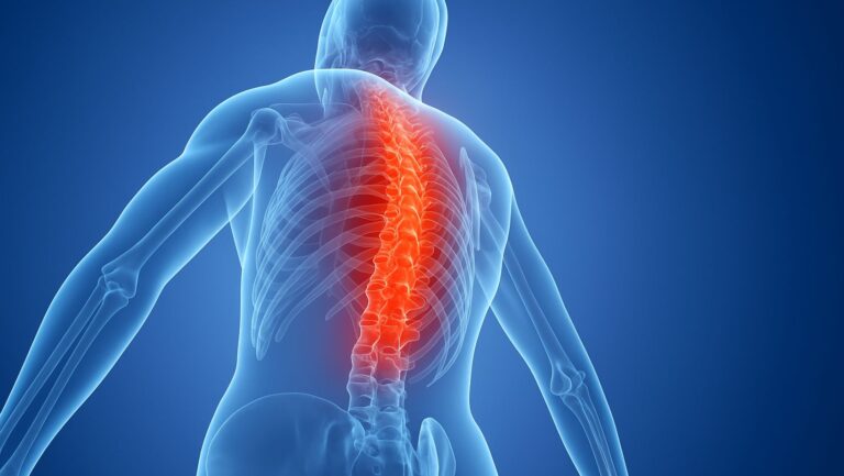 Havendo indicação médica, o plano de saúde deve cobrir a neuroestimulação medular.