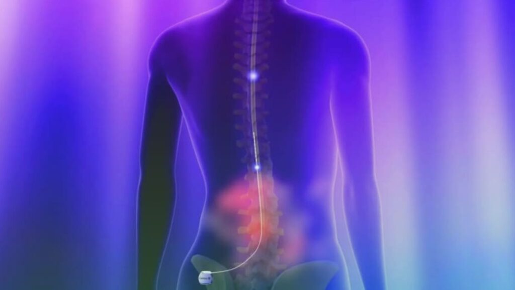 Havendo indicação médica, o plano de saúde deve cobrir a neuroestimulação medular.