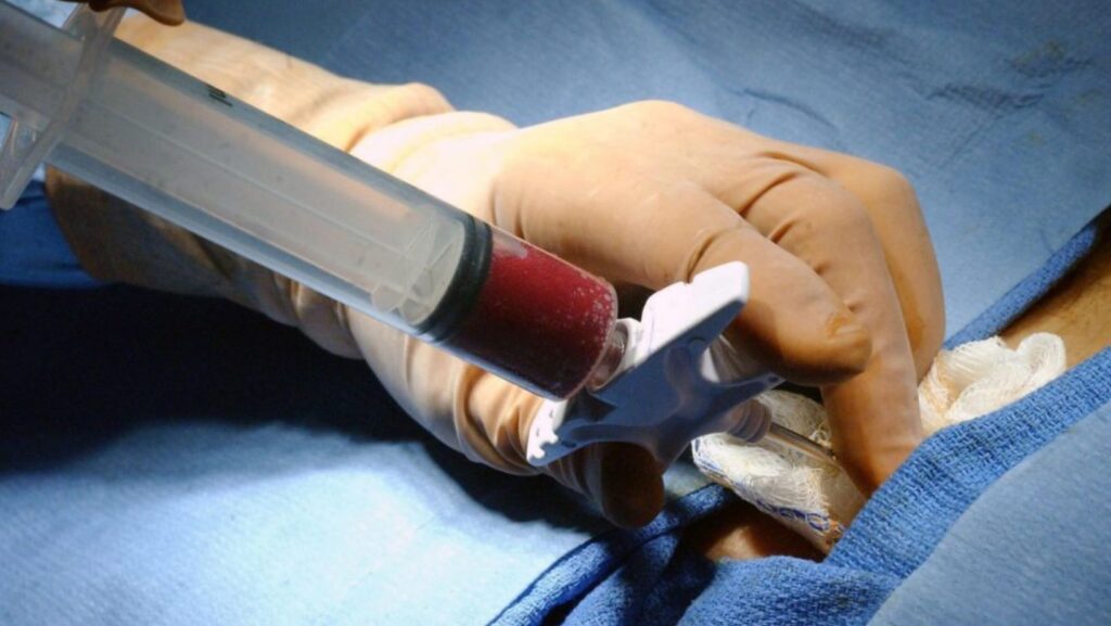 Havendo indicação médica, o plano de saúde deve cobrir o Transplante autólogo e o alogênico de medula óssea.
