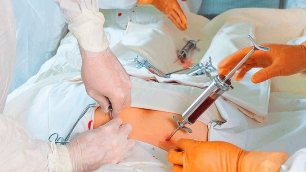 Havendo indicação médica, o plano de saúde deve cobrir o Transplante autólogo e o alogênico de medula óssea.