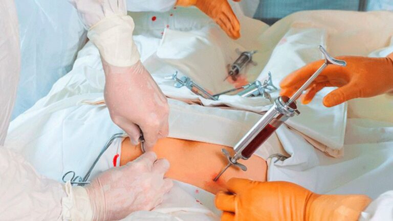 Havendo indicação médica, o plano de saúde deve cobrir o Transplante autólogo e o alogênico de medula óssea.